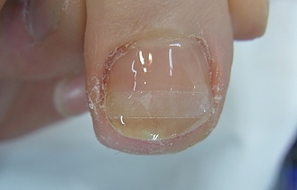 仙台巻き爪矯正院の爪甲鉤彎症症例２