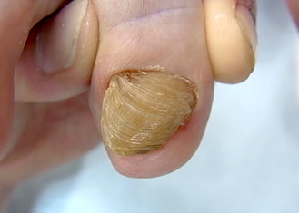 仙台巻き爪矯正院の爪甲鉤彎症症例１