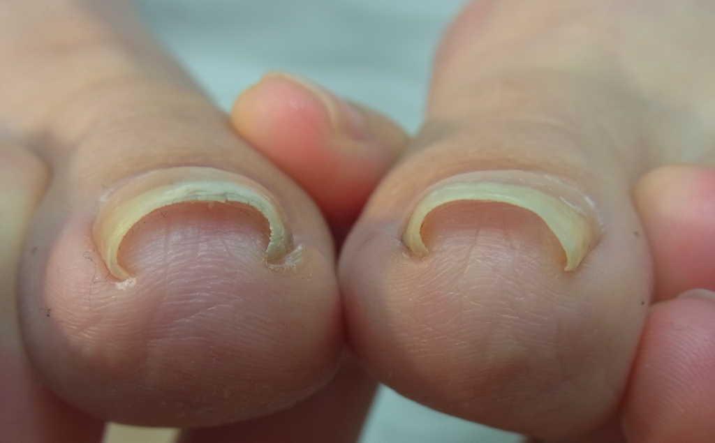 変形爪と肥厚爪 仙台市の巻き爪矯正治療なら 仙台巻き爪矯正院