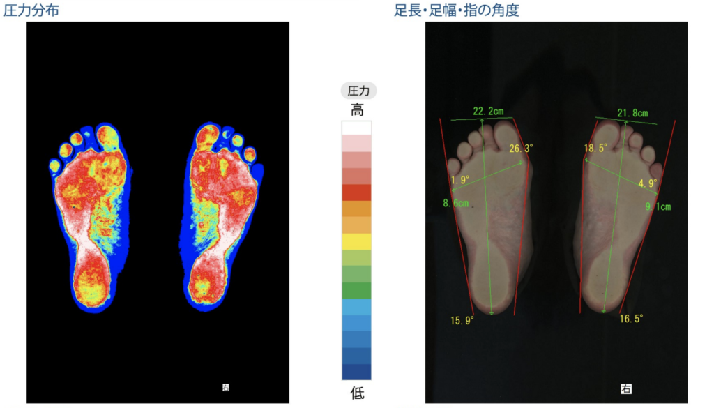 フットプリントで足裏の圧力分布と外反母趾の計測ができる